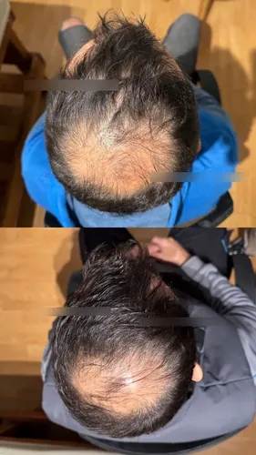 Loción Anticaida 5%, Fortalece, Crece Y Nutre El Cabello