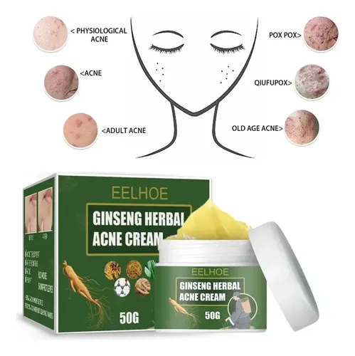 Crema Para El Acné Con Ginseng, 50 G – Oil Control,;