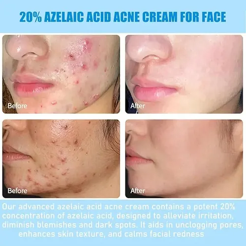 Crema Facial Para El Acné Con Un 20% De Ácido Azelaico,