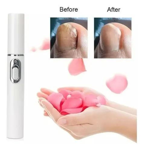 2×pluma Hongos Uñas Calientes Pluma Láser Luz Azul