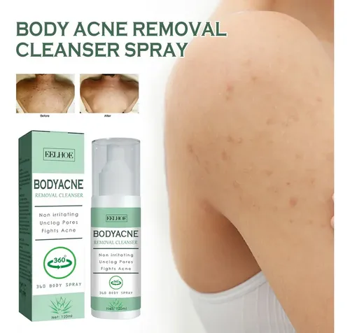 3×spray For Eliminar El Acné Corporal For Espalda, Cuello .