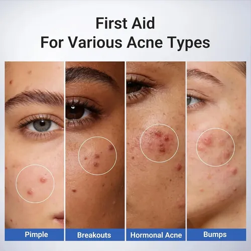 /crema Para Tratar La Acné, Ácido Salicílico Con Efecto Anti