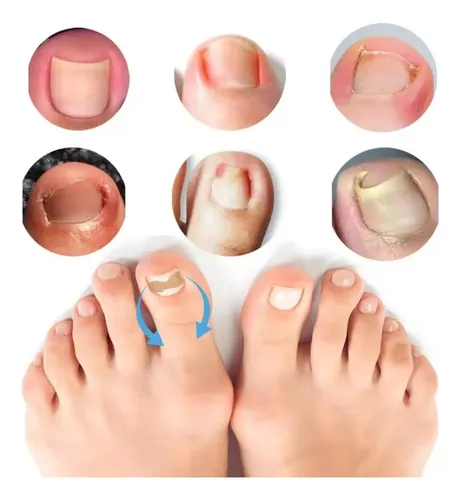 Spray Onicomicosis Tratamiento + Parche Cinta Ortesis X10 Neutra