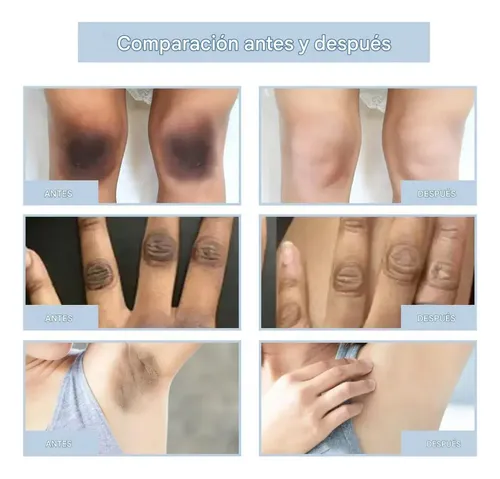 .zd Crema De Acantosis Nigricans, Mejora La .jh