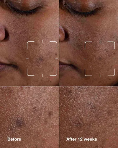 Suero Facial Even Better Clinical Dark Spot Clearing Serum