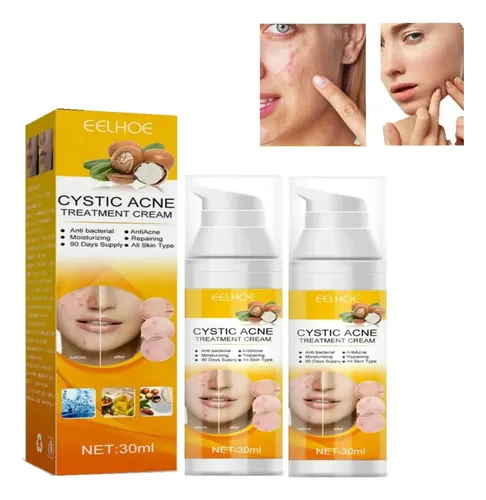2×crema Para Tratar El Acné Combate El Acné Quístico Hormon Todo Tipo De Piel