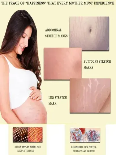 Xt La Crema Oedo Rose De X Skin Care Elimina Las Estrías Y W