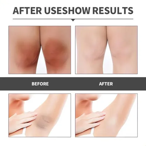 Crema Para Eliminar Manchas Oscuras En Áreas Íntimas, 30 Ml,