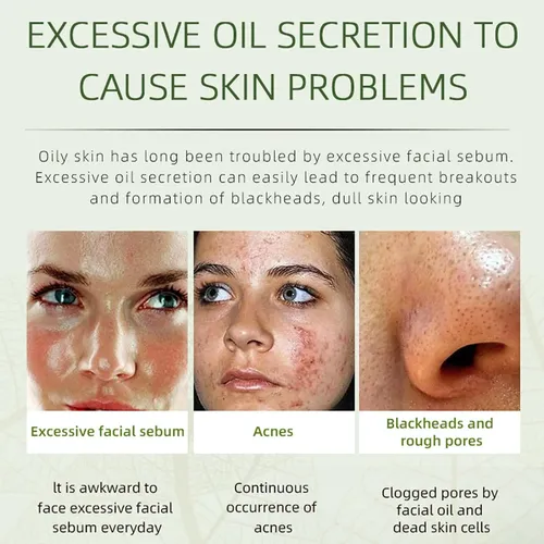 Crema Facial Para Eliminar El Acné, Ingredientes Naturales D