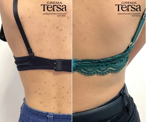 Mzcrema Tersa Despigmentante Quita Manchas Acné Paño De 40gm