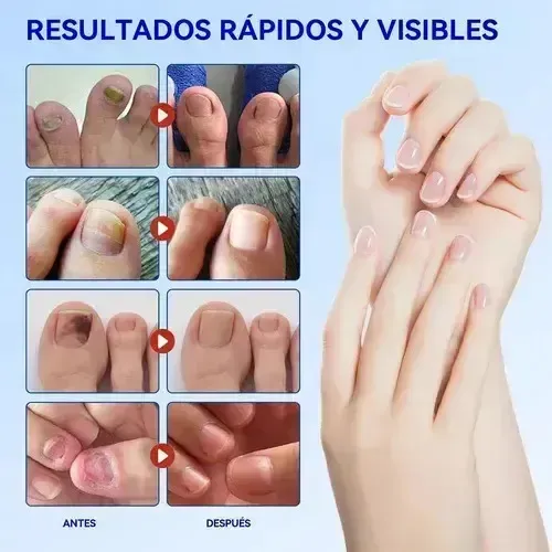 Parches Para Uñas Jf Fungal, 63 Unidades