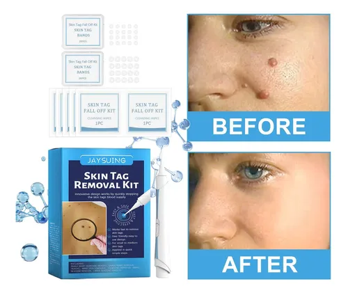 Skin Mole Remover Ii, Kit 2 En 1, Etiqueta Para Eliminar Man