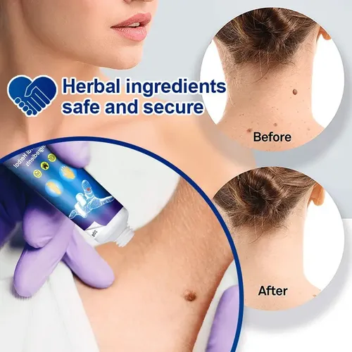 Crema Eliminadora De Verrugas Zs, Rápida Y Fácil, Pomada, 20