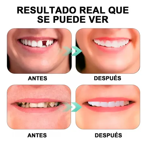 Funda Dental Flexible y Dentadura Cosmética Provisoria para Sonrisa Perfecta