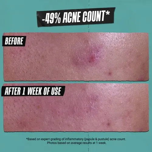 Pasta Limpiadora Antiacné Gently Effective 125ml Kiehl S Acneica Día/noche