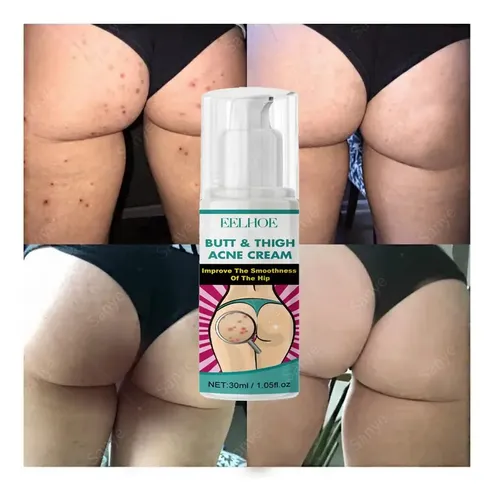 Crema For El Acné, Limpieza De Manchas Oscuras, Espinillas –