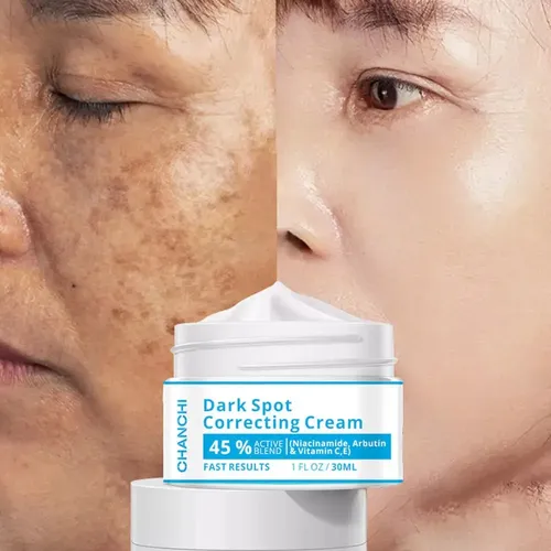 M* Crema Despigmentante Para Manchas, Vitíligo, Acné Y *xl
