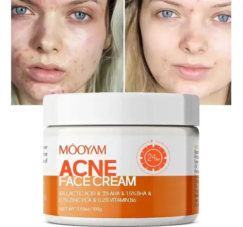 Dp10  Crema De Tratamiento Del Acné Para Espinillas, Puntos