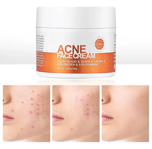 Crema Facial Antiacné Apta Para Todo Tipo De Piel Sensible.