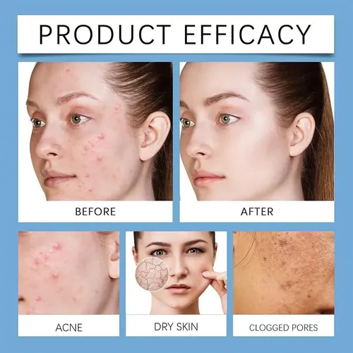 Bálsamo Para El Cuidado De La Piel Facial, Acné Y Enrojecimi
