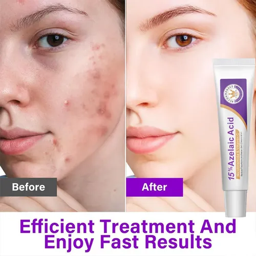 Crema Facial Hidratante Y No Pegajosa Con Un 15% De Ácido Az