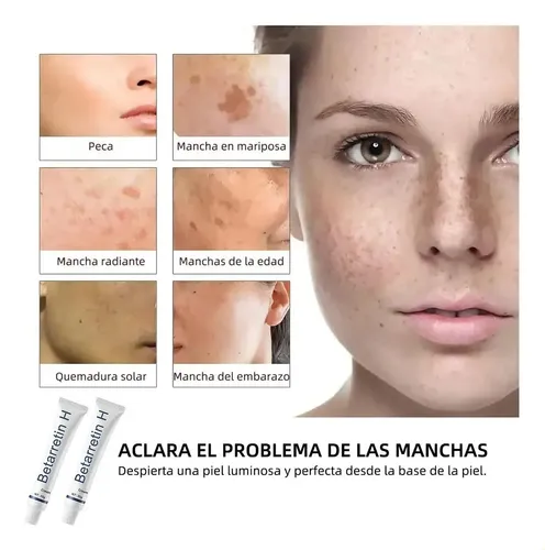 Creme Clareador, Creme De Hidroclorotiazida De Betametasona.