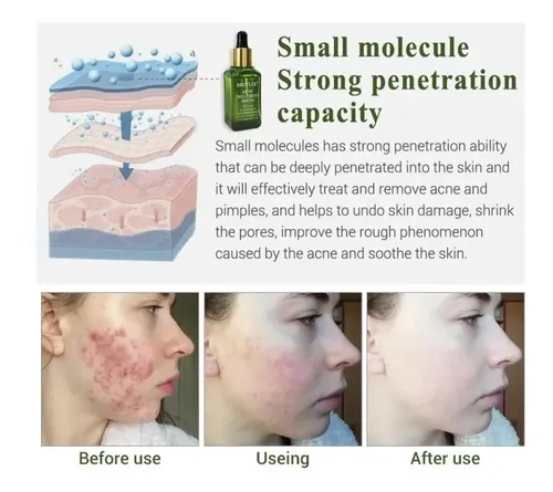 Tratamiento Para Acne Serum Comedones Pieles Grasas Importad