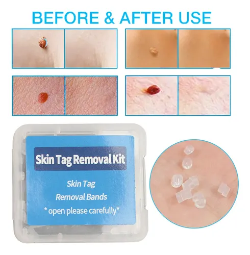 30pcs/box Flesh Non-toxic Removal Nevus Mole Bands  Ii No