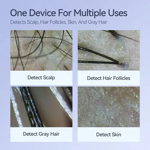 Máquina De Dermatoscopio, Analizador De Cuero Cabelludo Hd S