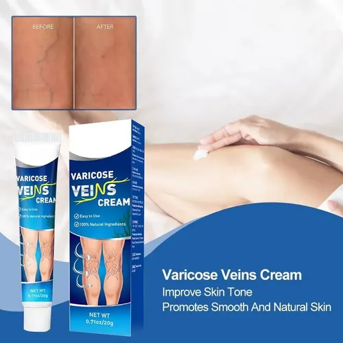 Crema Para Alivio De Varices Piernas Varicosas