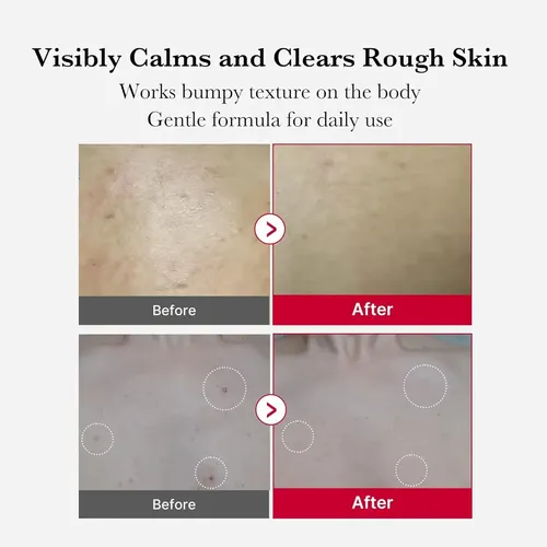 Medicube Red Acne Body Peeling Shot Exfoliante Corporal110ml