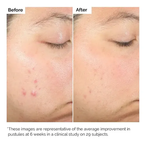 The Ordinary Salicilic Acid 2% Facial Serum 30mL
