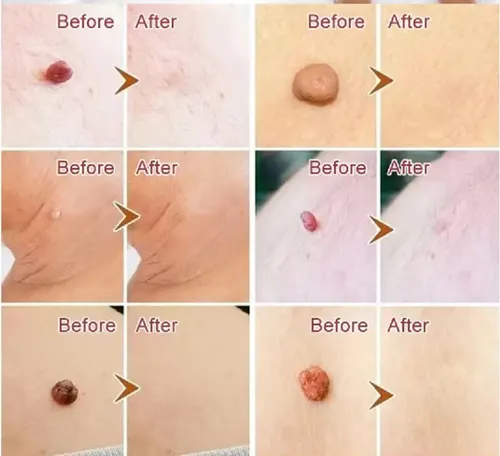 Crema para Eliminar Verrugas del Cuerpo con Propóleo y Fórmula Natural de 10 mL