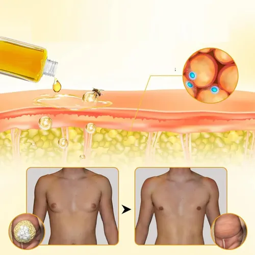Aceite Para Ginecomastia Con Veneno De Abeja Thermofirm, Nuevo Mú