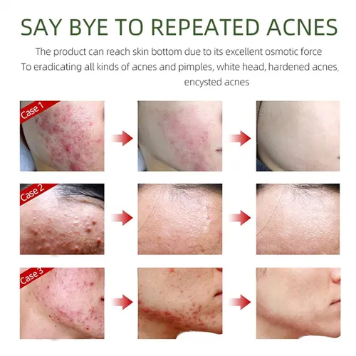 Crema Facial Para Eliminar El Acné, Ingredientes Naturales D