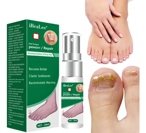 Tratamiento Spray Hongo Uñas Onicomicosis Micosis Pie Atleta