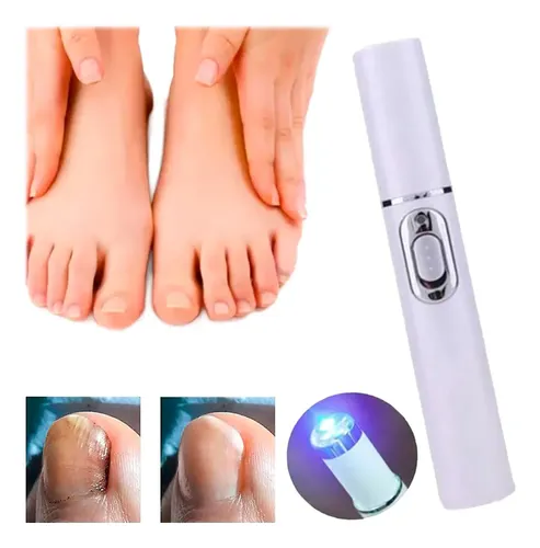 Tratamiento Láser Uñas Hongos Onicomicosis Manos Pies Eficaz