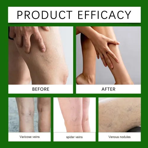 Crema Para Piernas Alivio De Edemas Para Piernas Y Pies