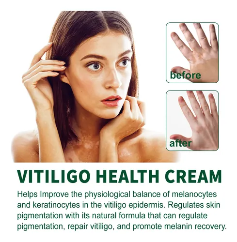Zgq Una Crema Blanca For El Vitíligo, Aceite De Vitiligo K