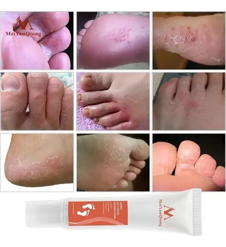 Crema Fitoterapia Para Tartas Y Antihongos