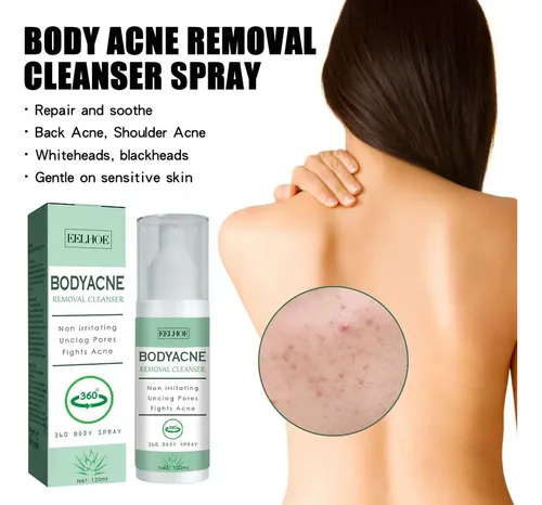 3×spray For Eliminar El Acné Corporal For Espalda, Cuello .