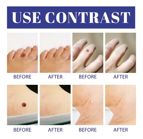 Skin Mole Remover Ii, Kit 2 En 1, Etiqueta Para Eliminar Man
