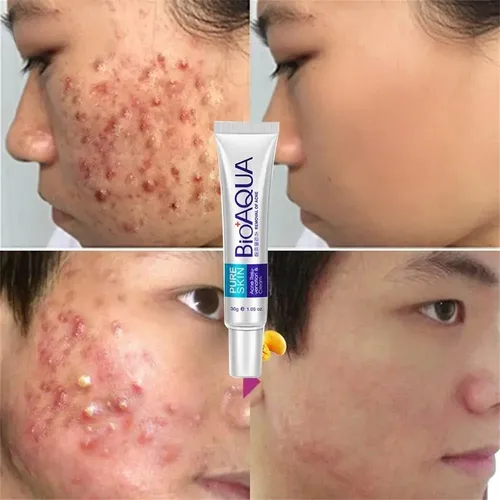 Gel Anti Acne Descongestivo Suavizante Poros Cerrados Lanben