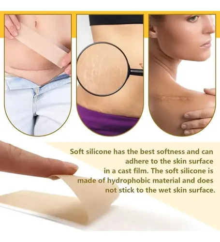 Cinta Cicatriz Cesarea Gaon Heridas Cuerpo Cirugia Queloide