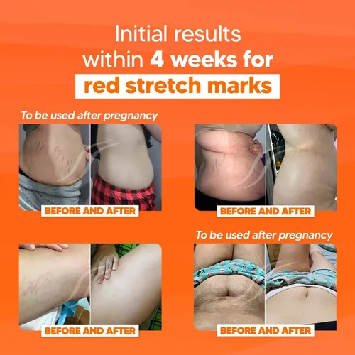 Crema Cicatrissim 150 Ml Estrías Profundas Y Elasticidad