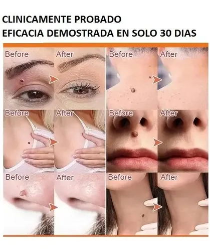 Loción Eliminadora De Verrugas Para Cara, Cuello Y Genitales