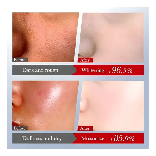 Kit Skincare Sadoer Ácido Kójico Blanqueador X6 Productos