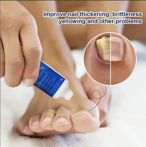 Crema Anti Hongos De Uñas Ataca Onicomicosis Pies Salud Fragancia Herbal
