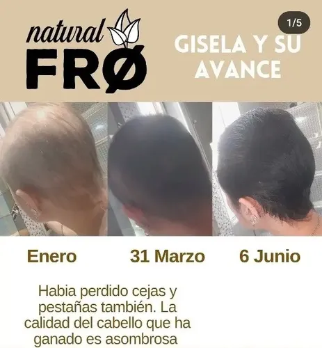 Loción Capilar Naturalfro Crecimiento Calvicie Caida X 400ml