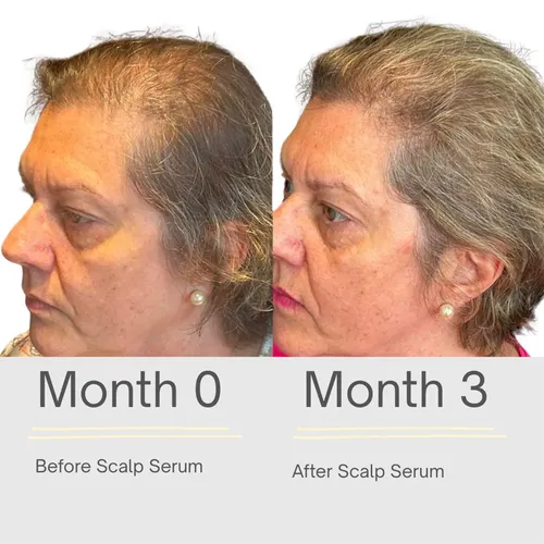 El Sérum Para El Crecimiento Del Cabello Limpia Suavemente E